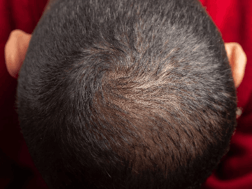 Androgenetic Alopecia