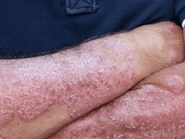 Psoriasis