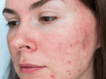 Rosacea