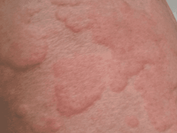 Urticaria