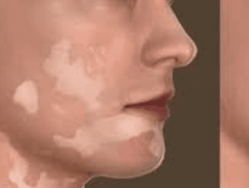 Vitiligo Surgeries